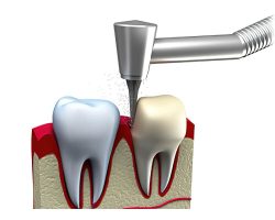 Coroas Dentárias 01
