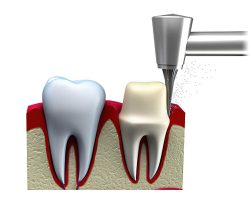 Coroas Dentárias 02
