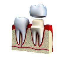 Coroas Dentárias 03