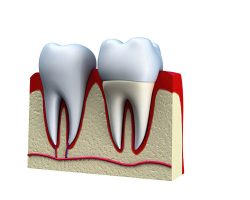 Coroas Dentárias 04