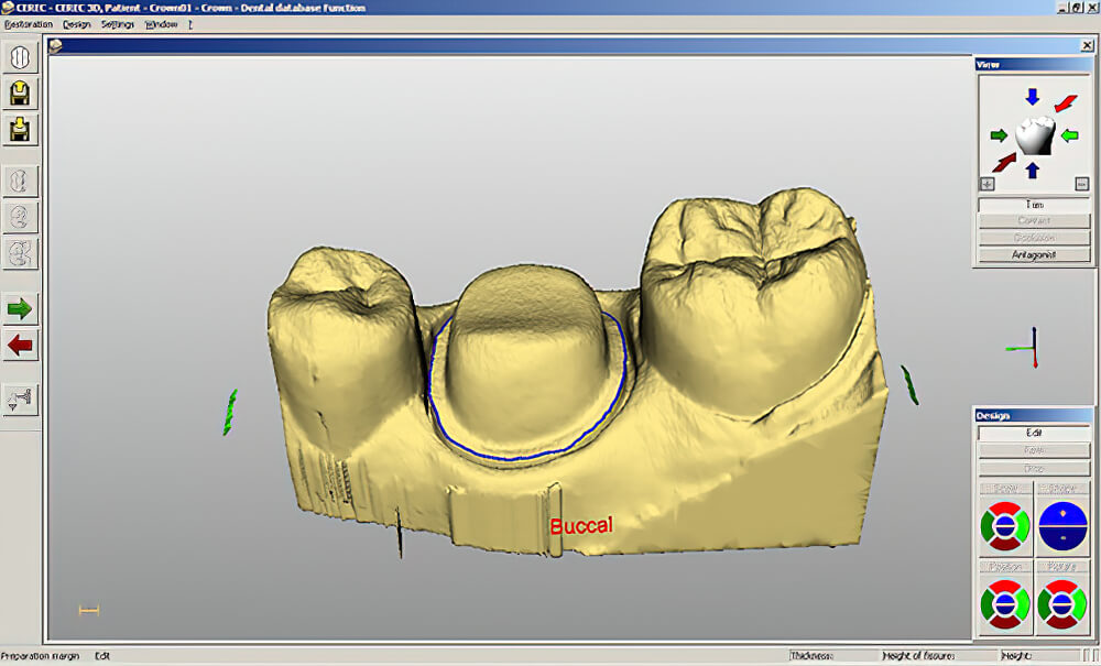 Scan 3D CAD CAM 02